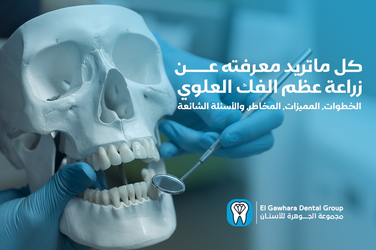 زراعة عظم الفك العلوي