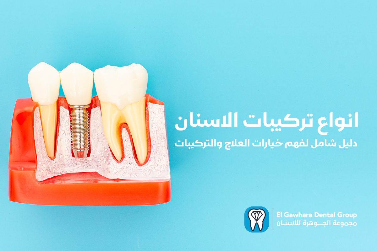 انواع تركيبات الاسنان