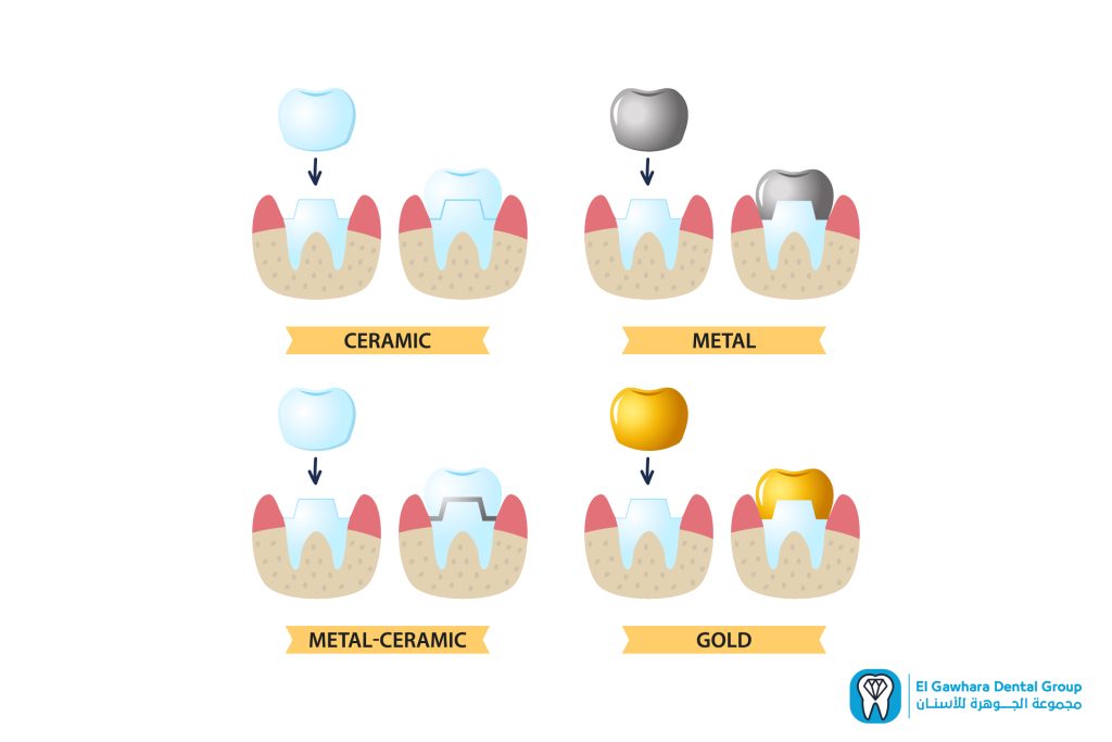 افضل انواع حشو الاسنان