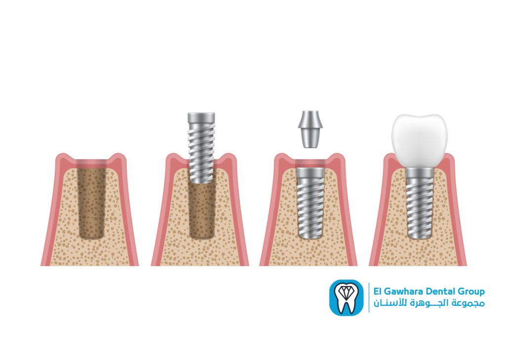 تكلفة زراعة الاسنان