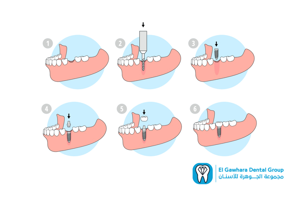 خطوات زراعه الاسنان