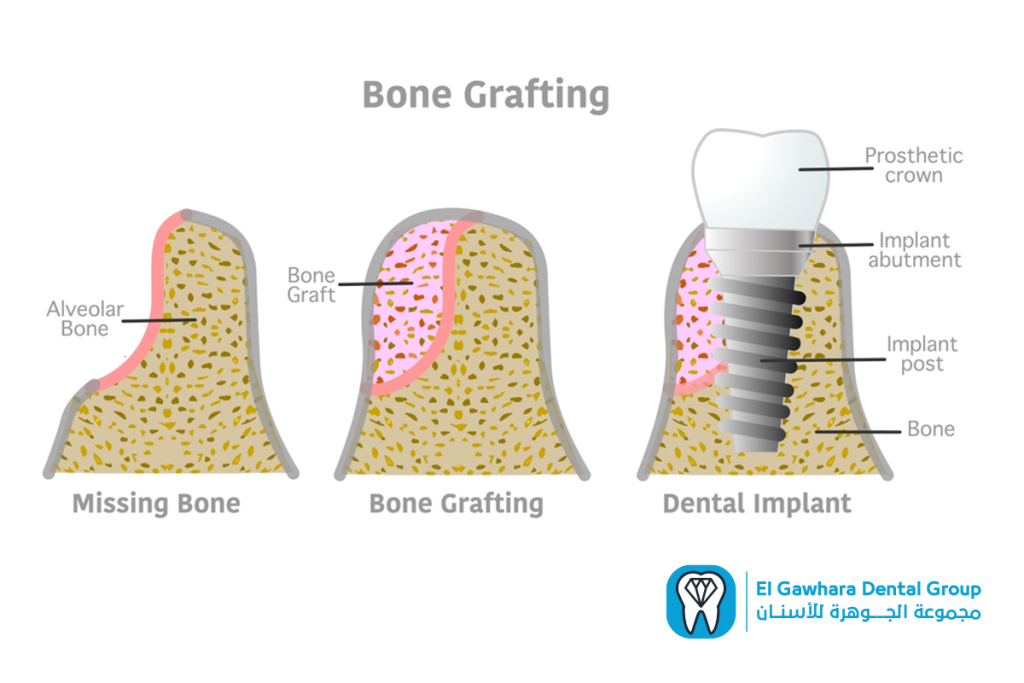 خطوات زراعه الاسنان