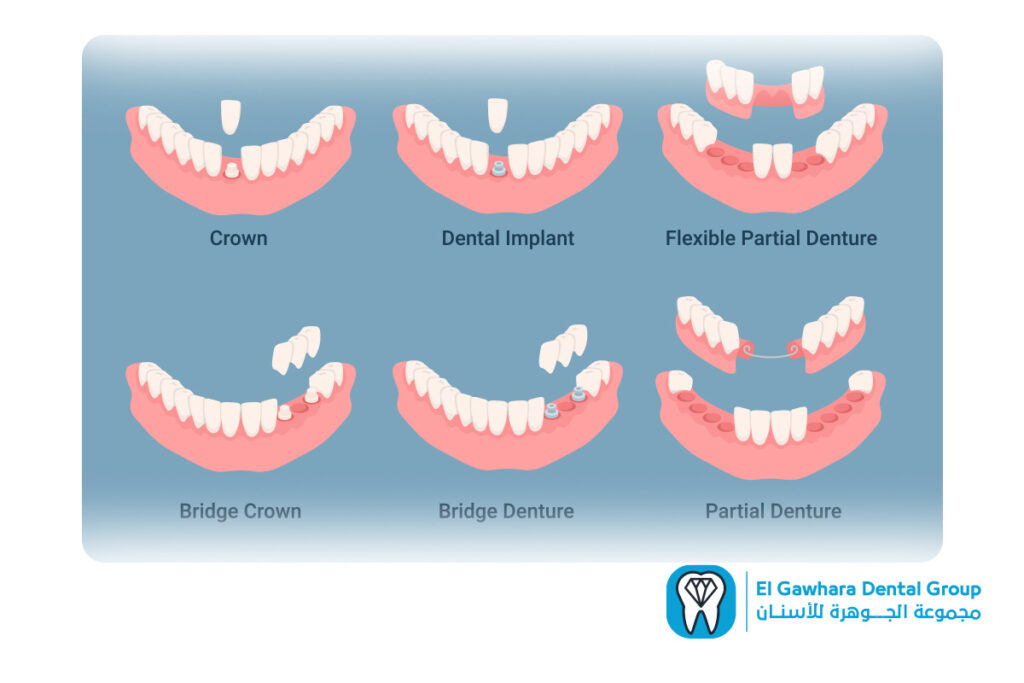 انواع زراعة الاسنان​