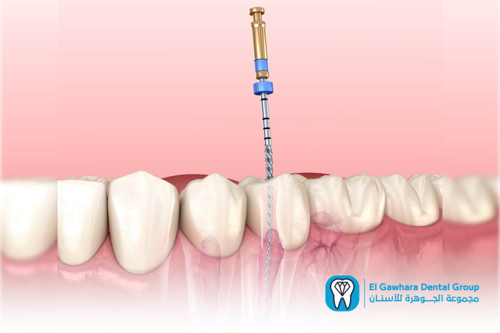 دكتور علاج جذور الاسنان