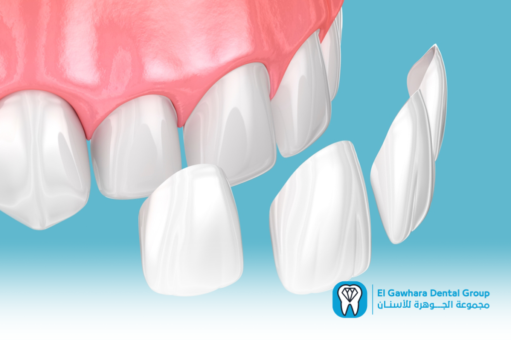 اسعار تركيب ابتسامة هوليود