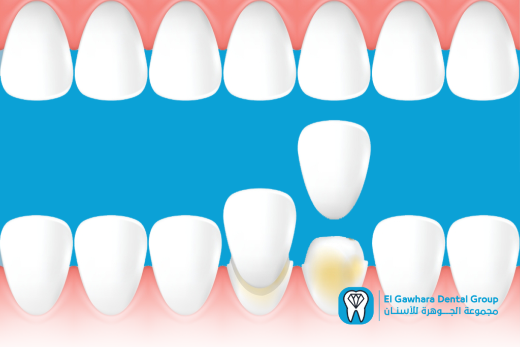 تكلفة hollywood smile