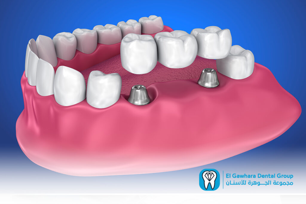 اسعار التركيبات الثابتة للاسنان