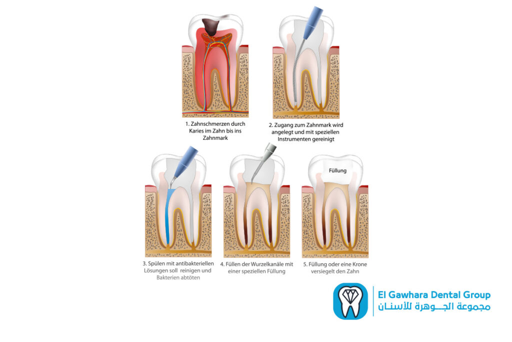 علاج جذور الاسنان​