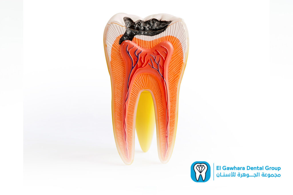 علاج جذور الاسنان​