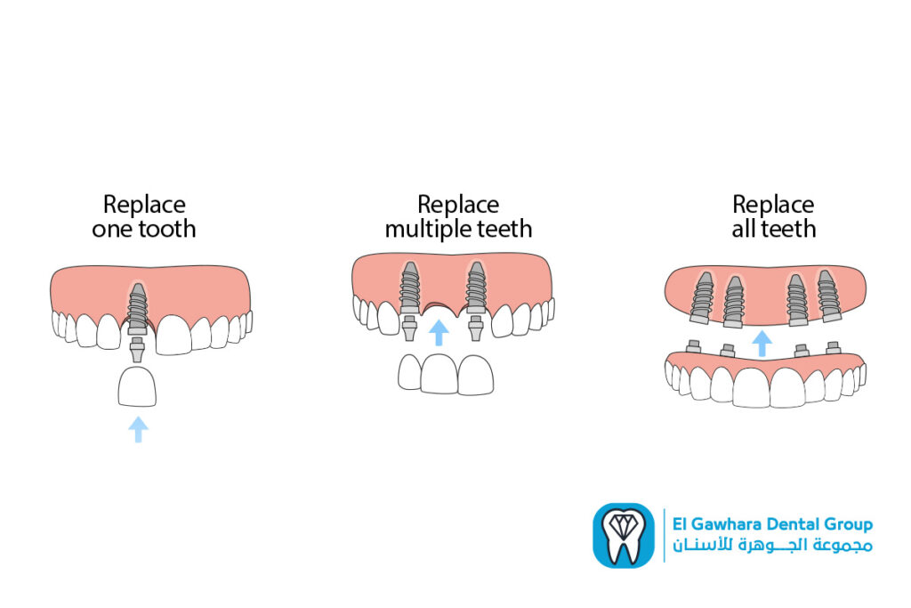 انواع زراعة الاسنان​