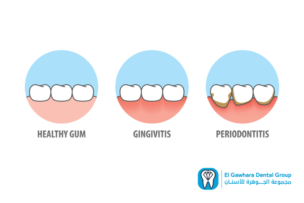 تورم اللثة اسبابه وعلاجه​