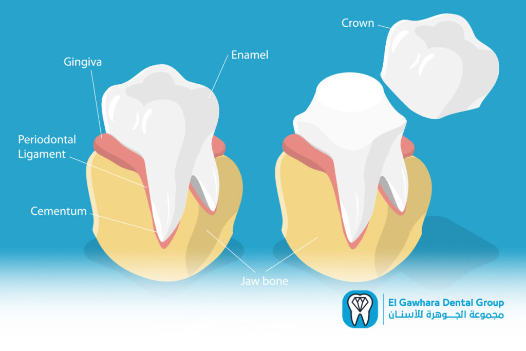 الحشو التجميلي للاسنان​