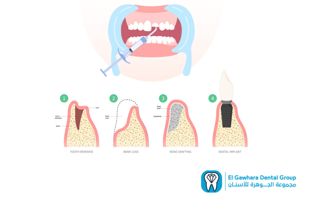 عملية زراعة عظام الاسنان​