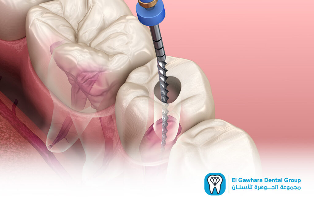 علاج التهاب عصب الاسنان​