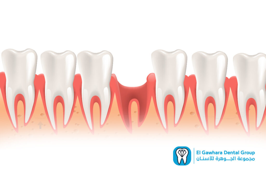 اسباب تاكل عظام الاسنان​