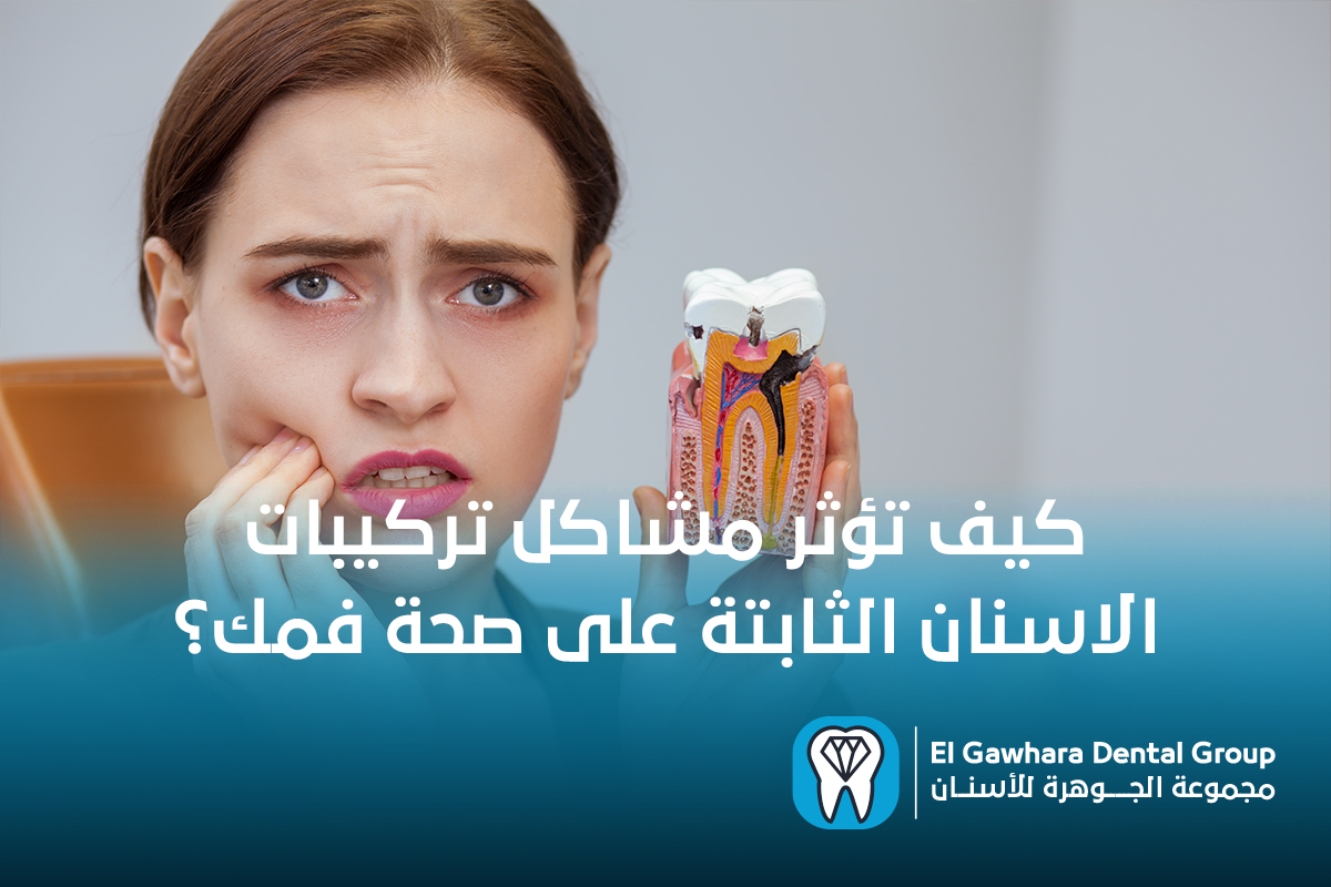 مشاكل تركيبات الاسنان الثابتة​