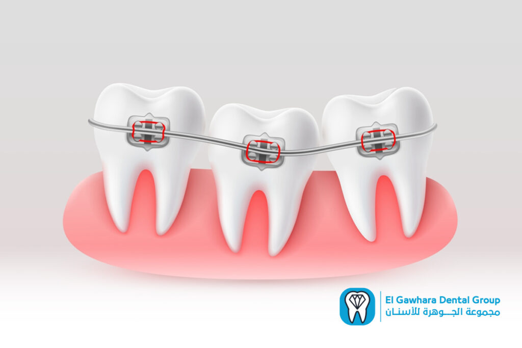 تكلفة تقويم الاسنان​