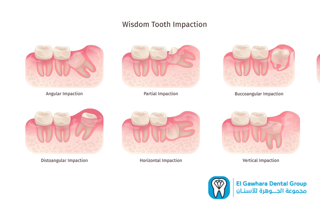 اعراض ضرس العقل المدفون​