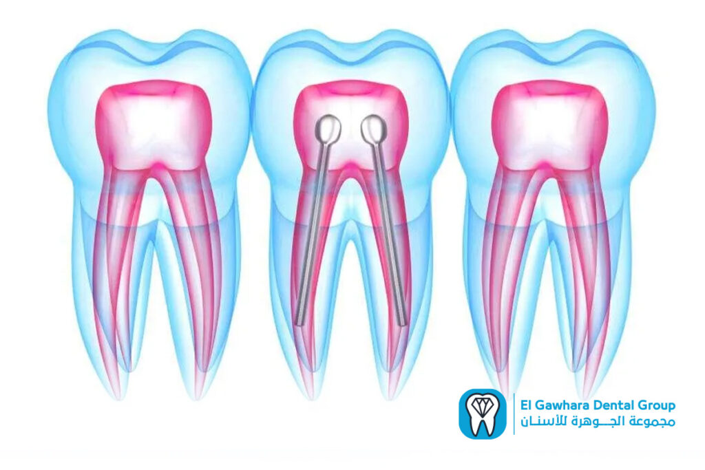 ما هي دعامة الاسنان​